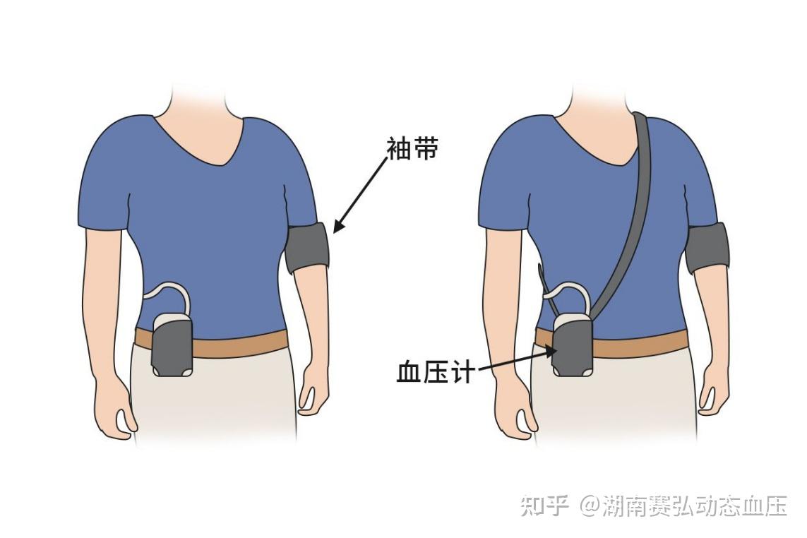 動(dòng)態(tài)血壓監(jiān)測(cè)血壓管理的“偵察兵”