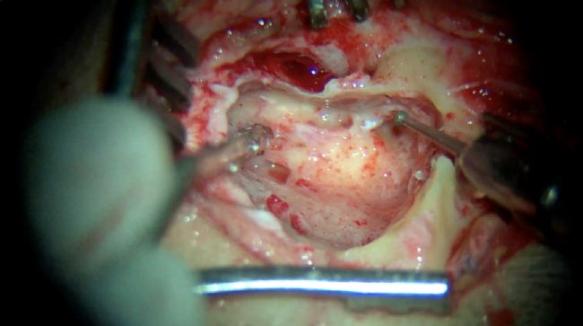 案例分享 | 人工耳蝸植入+迷路切除術